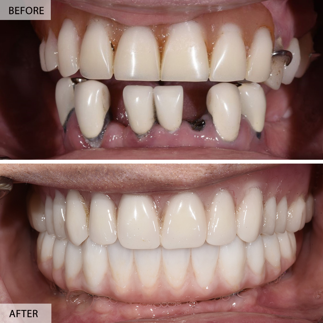 Dental Implants Before & After